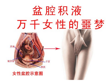 盆腔积液
