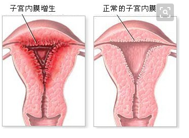 子宫内膜增厚怎样调理？