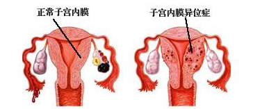 子宫内膜异位症病因