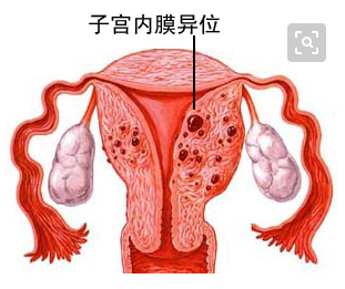 子宫内膜异位症病因