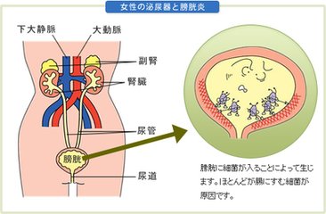 膀胱炎怎样治疗