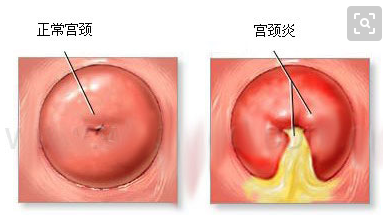 宫颈炎的症状和治疗