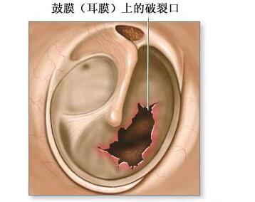 耳膜破裂判断