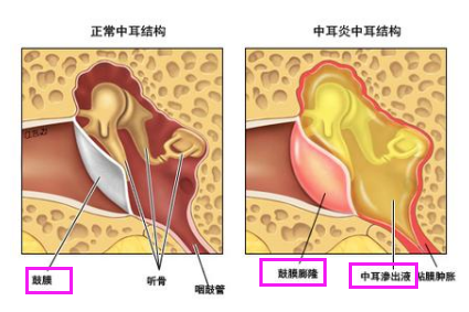 化脓性中耳炎,鼓膜穿孔