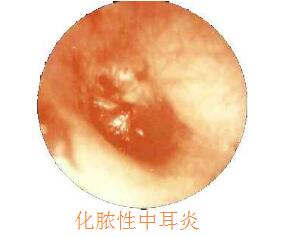 化脓性中耳炎病因