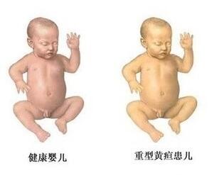 科研家发现新生儿病理性黄疸新病因