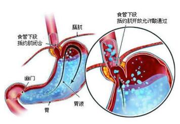 胃食管反流病并发症