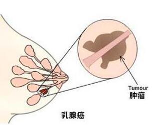 晚期乳腺癌新药物