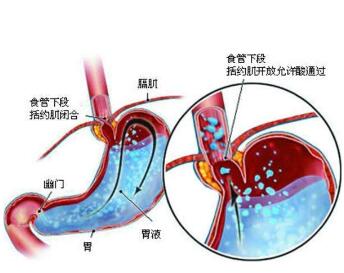 胃食管反流日常保健