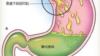 胃食管反流日常保健