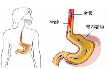 胃食管反流病因