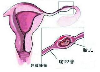 盆腔炎致宫外孕