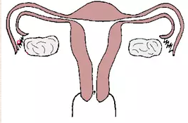输卵管积水的原因