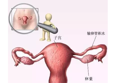 怎样知道输卵管有没有积水