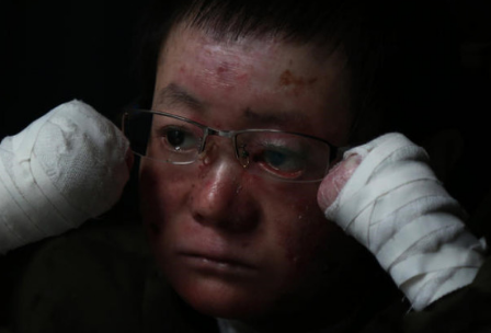 男生患罕见病  5成皮肤没表皮