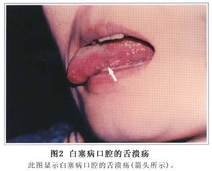 罕见病白塞病