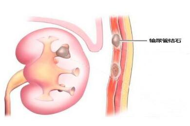 输尿管结石示意图