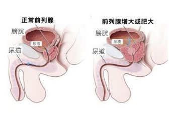 前列腺增生引发肾积水