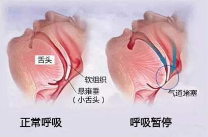 睡眠呼吸暂停