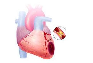 心肌梗塞纳米颗粒治疗
