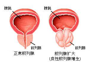 预防保健前列腺增生