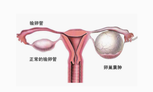 卵巢囊肿