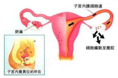 子宫内膜异位症治疗