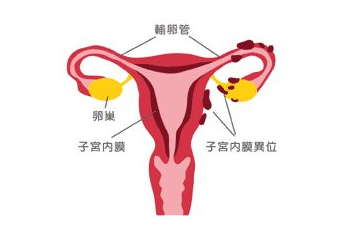 子宫内膜异位症引发腹痛