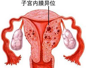 子宫内膜异位症,治疗
