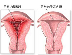 子宫内膜增厚,治疗