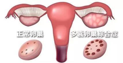 多囊卵巢综合症
