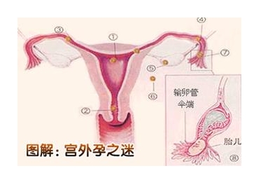 宫外孕,腹腔妊娠