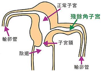 子宫残角妊娠
