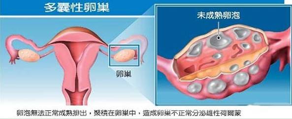 多囊卵巢综合征的治疗