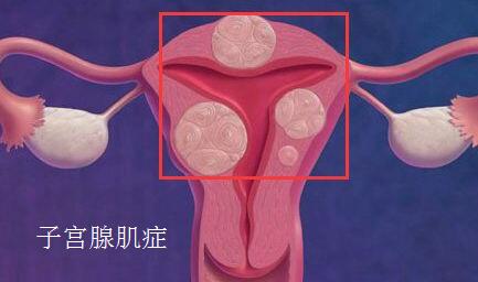 上环能治疗子宫腺肌症吗？