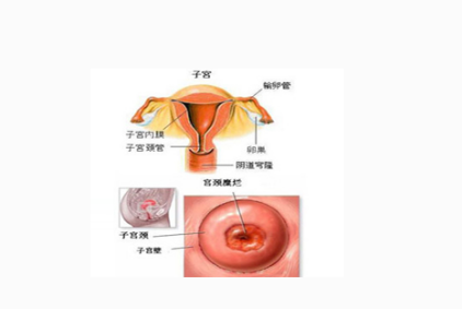 宫颈炎和宫颈糜烂区别