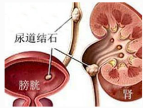 尿道结石引起的尿路感染