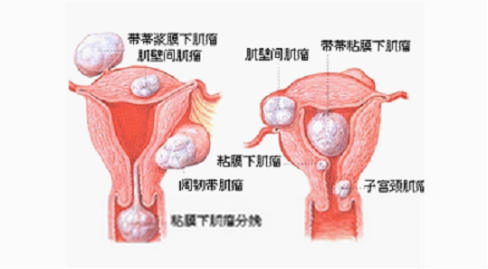 子宫肌瘤能自愈吗