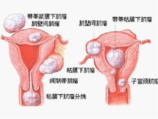 子宫肌瘤