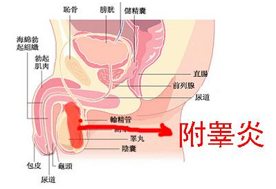 附睾囊肿