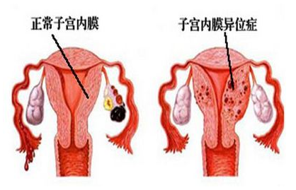 子宫内膜异位症痛经