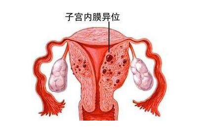 流产致子宫内膜异位症