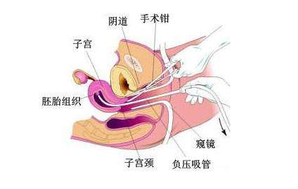 流产致子宫内膜异位症