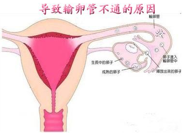 输卵管堵塞不通病因