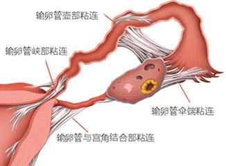 输卵管粘连