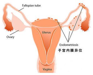 子宫内膜异位症,不孕