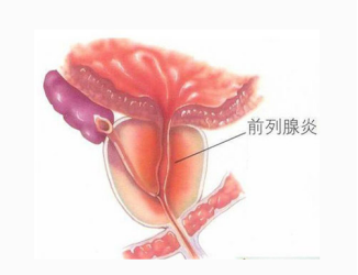 慢性前列腺炎危害