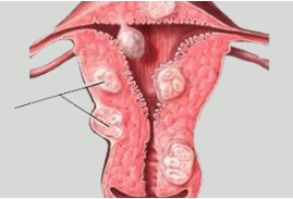 子宫肌瘤为何会导致不孕