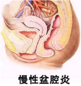 盆腔炎7.png