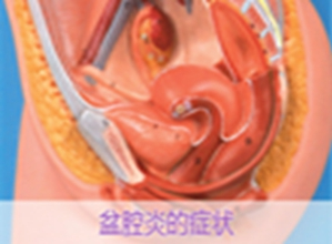 盆腔炎4.png